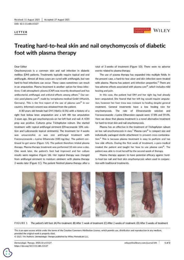 Terabe, Y., Kaneko, N. and Ando, H. (2021), Treating hard-to-heal skin and nail onychomycosis of diabetic foot with plasma therapy._compressed.pdf